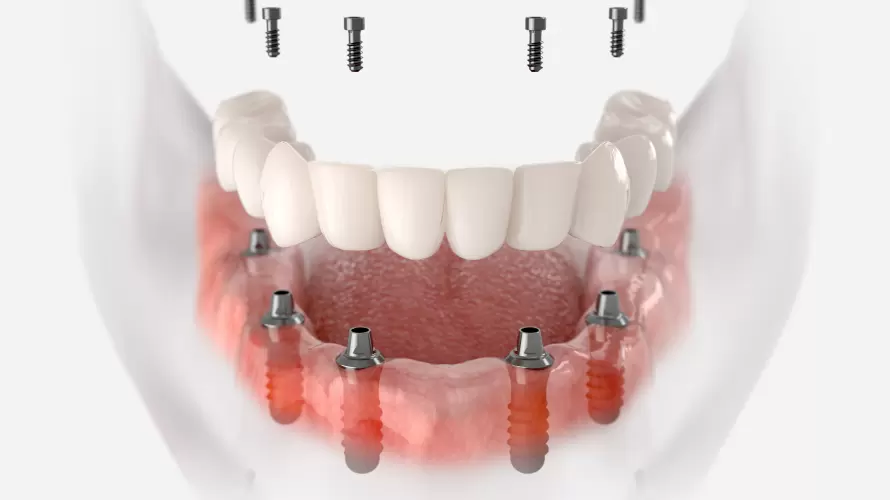 Zirkonyum mu Porselen mi: İmplant Üzerine Zirkonyum mu Porselen mi?