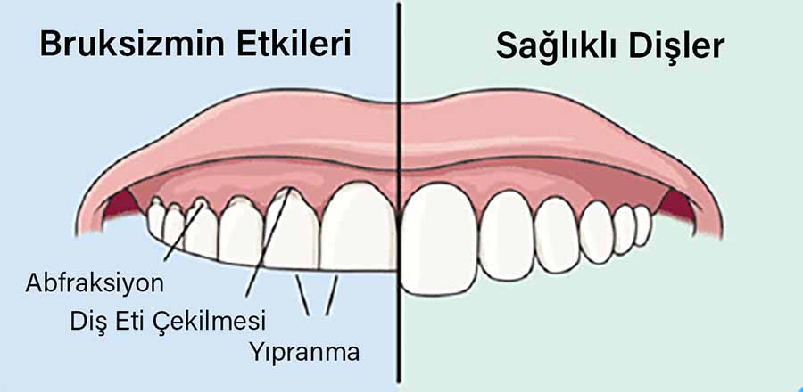 Bruksizm (Diş Gıcırtısı) İle Ortaya Çıkabilecek Komplikasyonlar Nelerdir?
