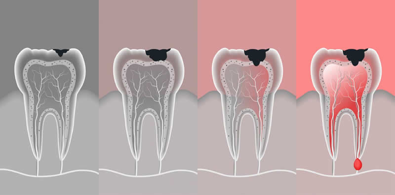 Dişlerimiz Neden Çürür?