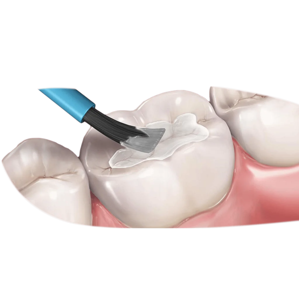 Florun Diş Sağlığı İçin Önemi Nedir?