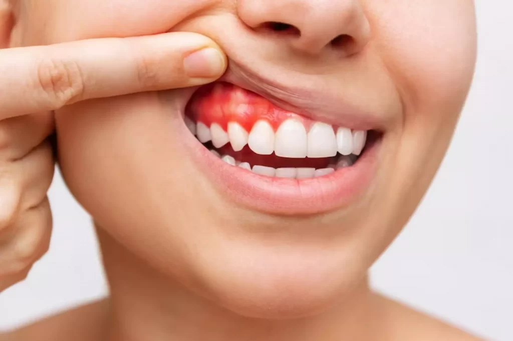 Akut Gingivit Nedir?