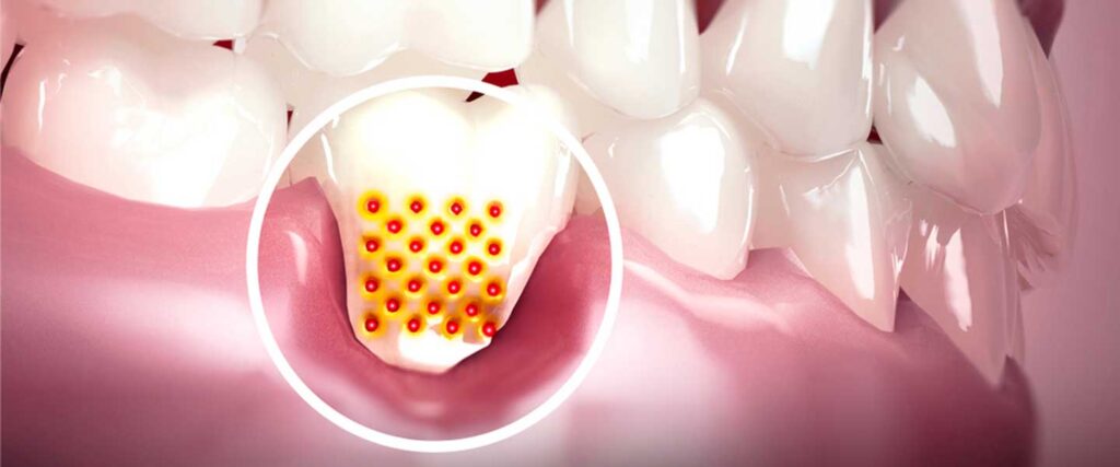 Diş Eti Çekilmesine Ne İyi Gelir?