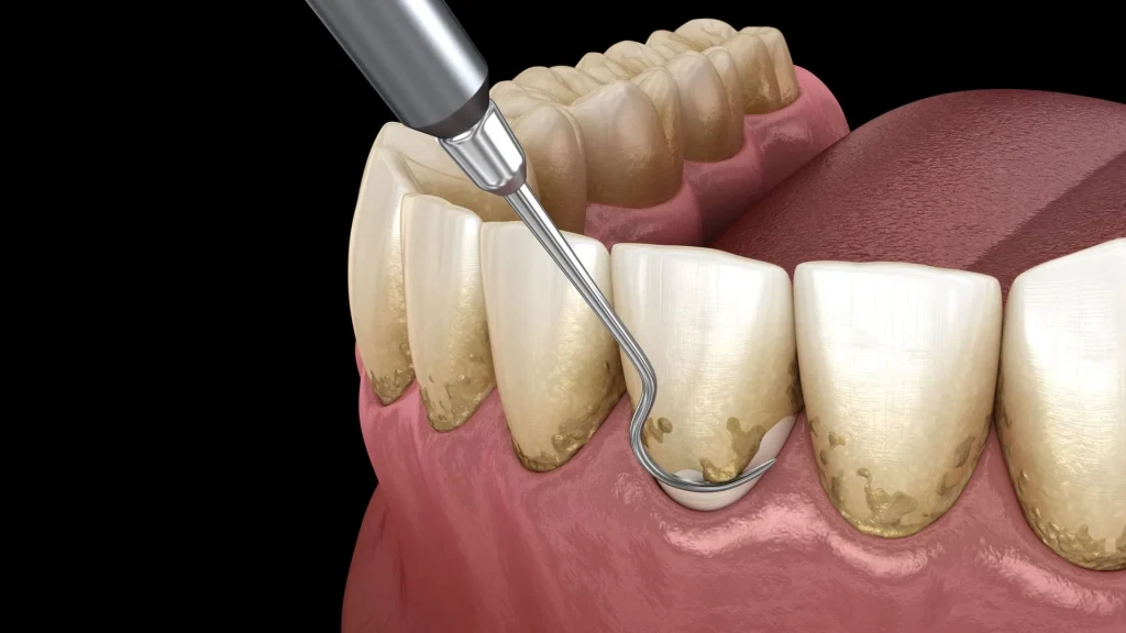 Diş Eti Çekilmesinin (Periodontitis) Tanısı Nasıl Konulur?