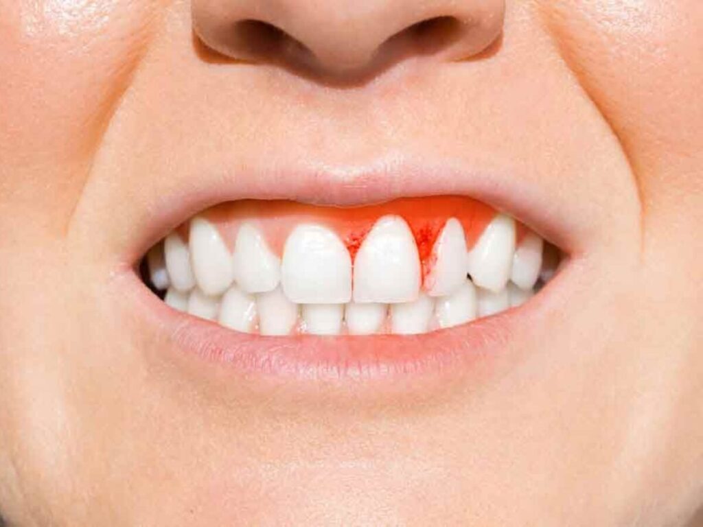 Gingiviti Önlemek İçin Neler Yapılabilir?