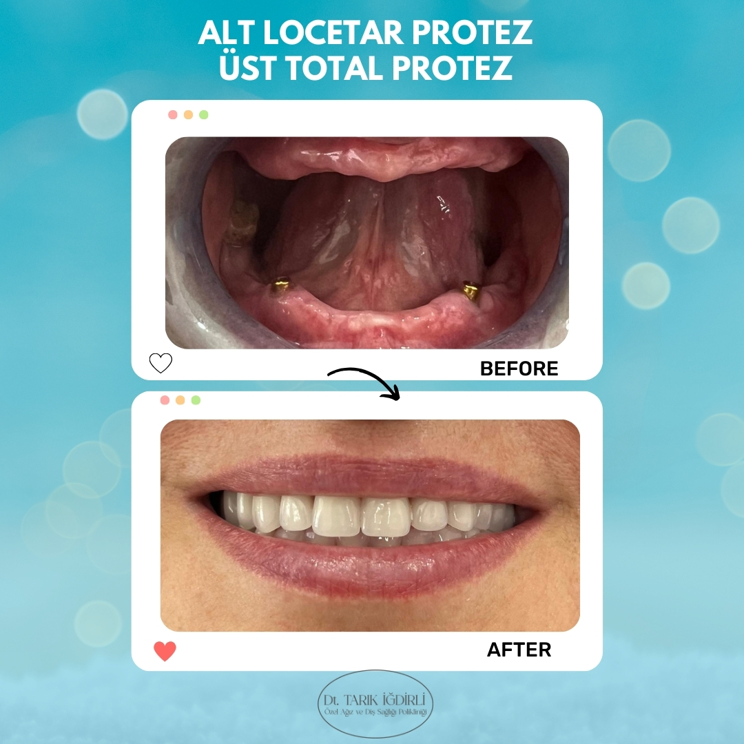 Diş Protezi