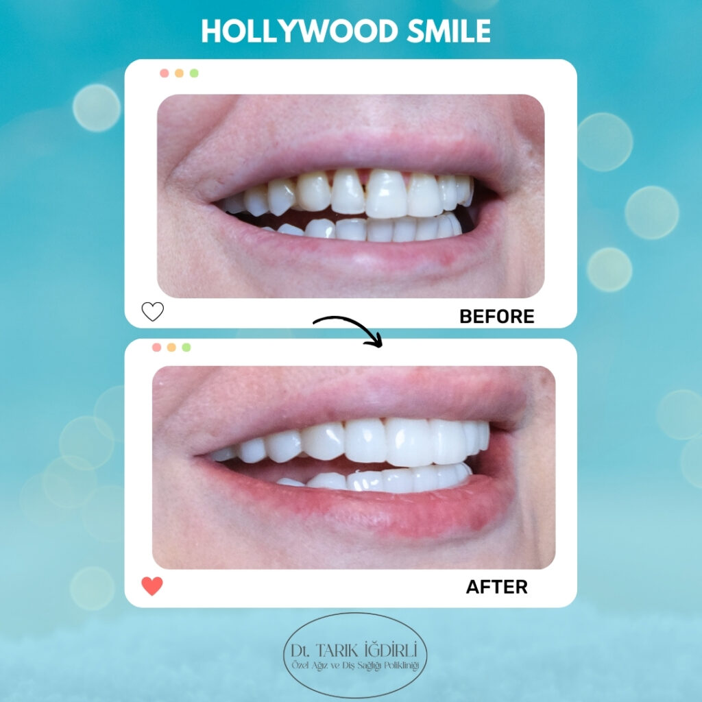Hollywood Smile Özellikleri