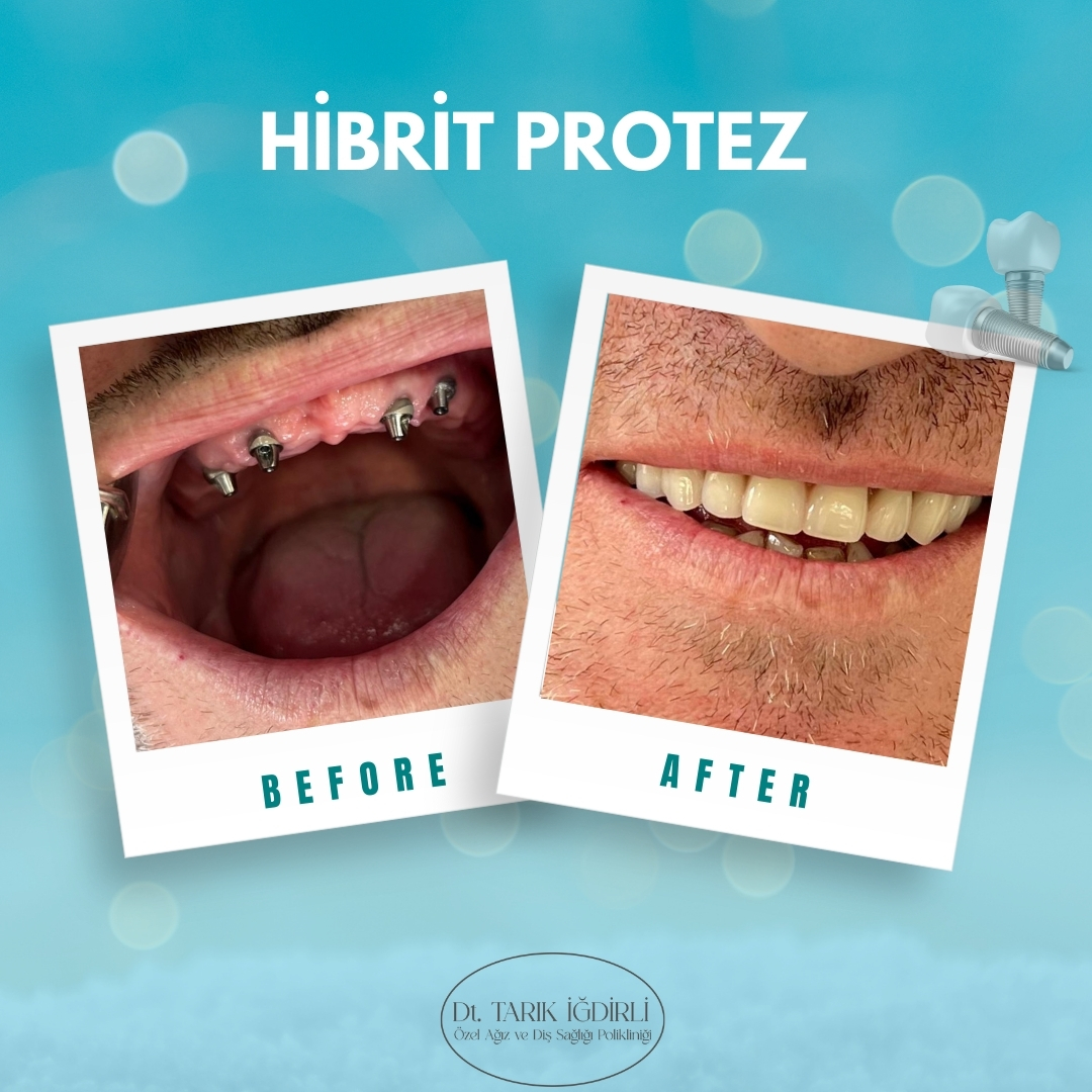 Hibrit Protez