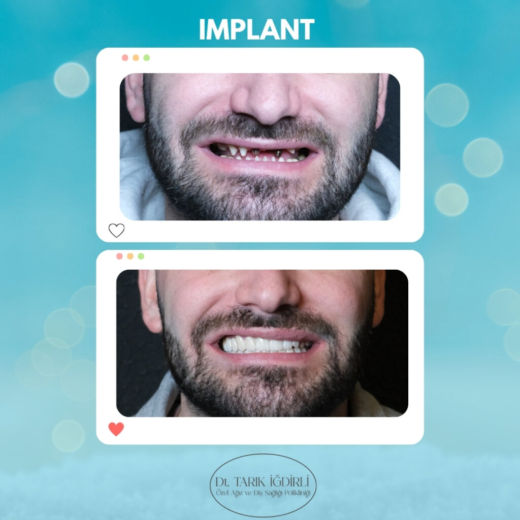 Diş İmplant