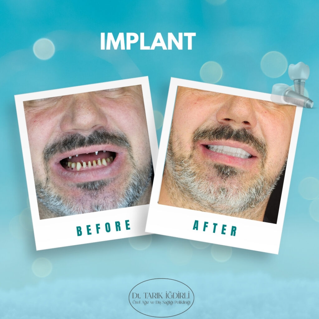 İmplant Nasıl Yapılır?