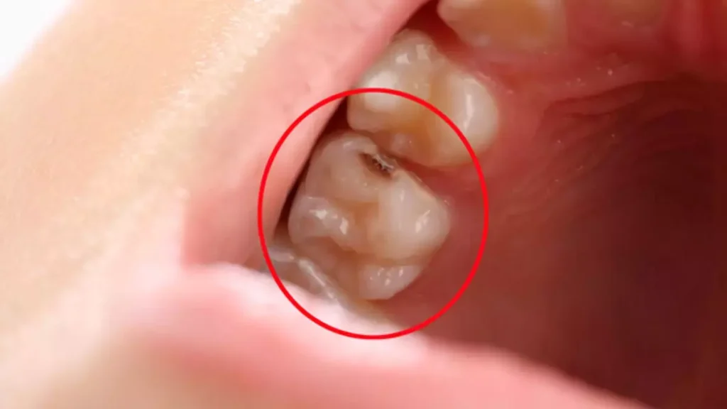 Çürük Diş Ağrısına Ne İyi Gelir?