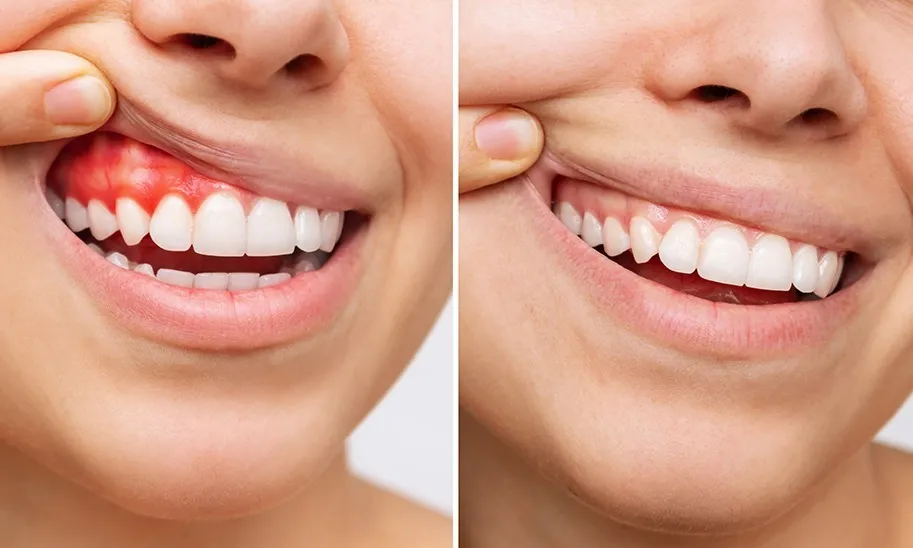 Diş Eti Şişmesi Hakkında Sık Sorulan Sorular