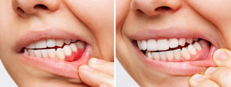 Diş Eti Şişmesi Nasıl Geçer?