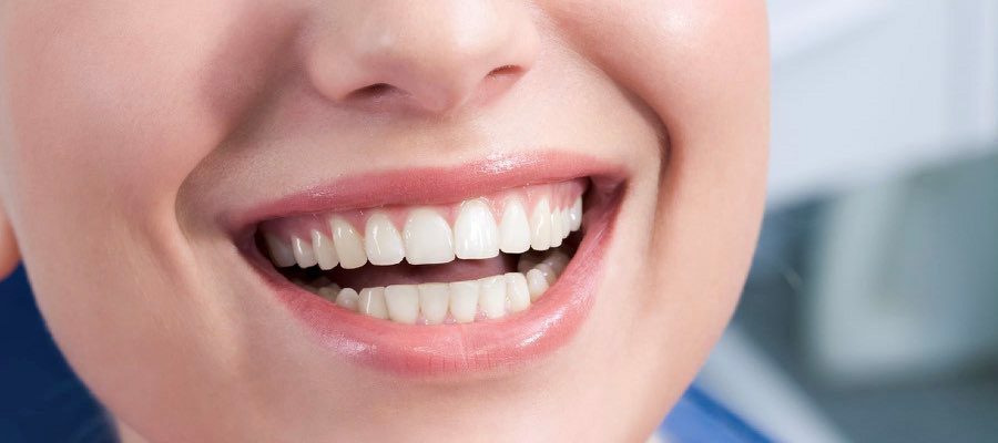 Estetik Diş Dolgusu Nedir?