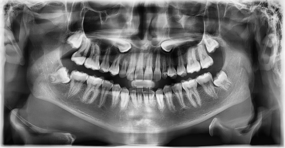 Gömülü diş neden olur?