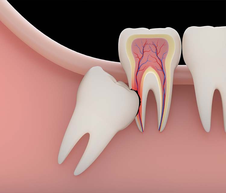 Gömülü diş tedavisi nedir?