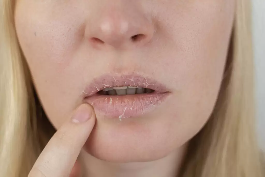 Ağız Kuruluğu Neden Olur? Ağız Kuruluğuna Ne İyi Gelir?