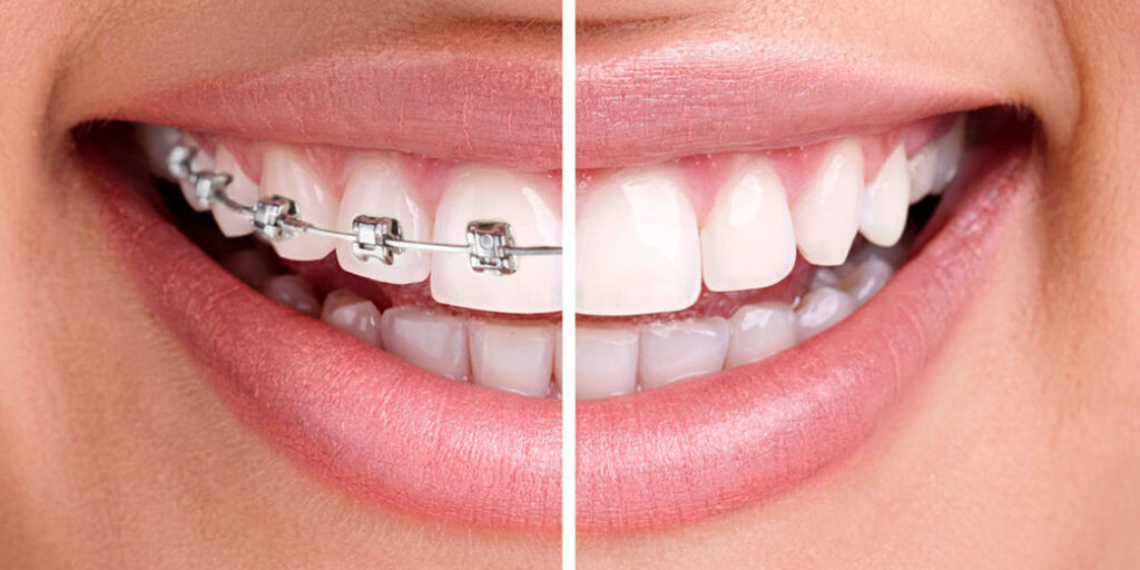 Braketlerin bakımı ve ağız temizliği için neler yapılmalıdır?