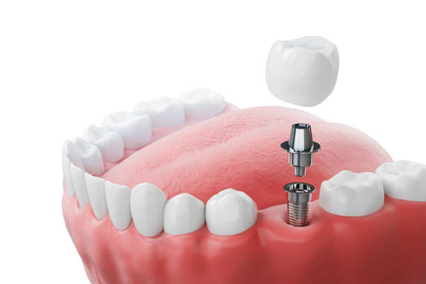 zigomatik implant