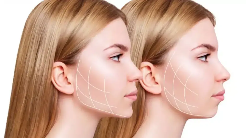 masseter botoksu